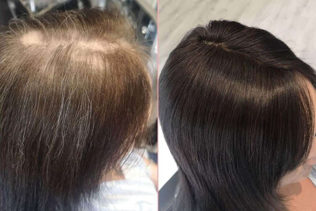 Hair Loss Integration Training 3