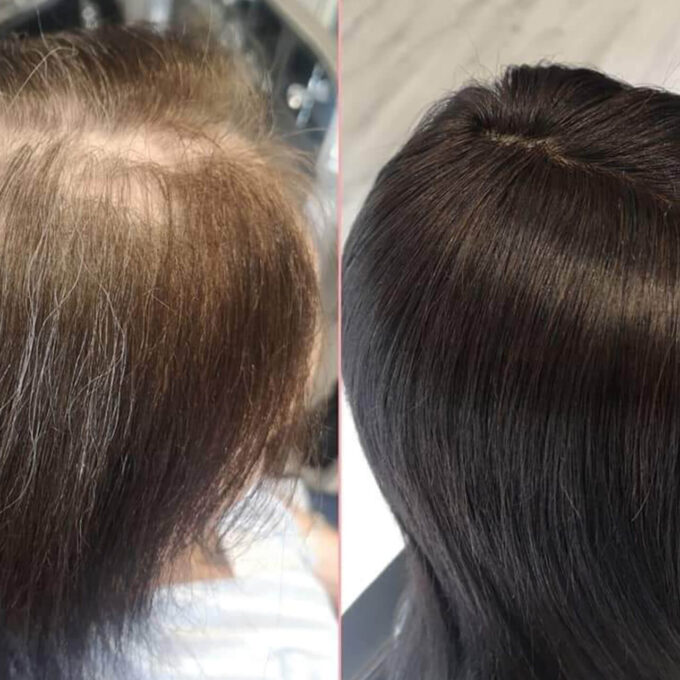 Hair Loss Integration Training 3