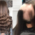 Hair Loss Integration Training 5