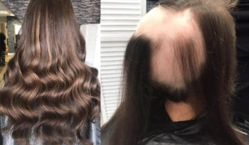 Online Hair Loss Integration Both Methods