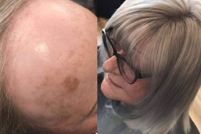 Hair Loss Integration Training 6