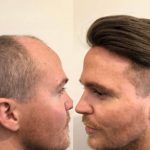 Hair Loss Integration Men's