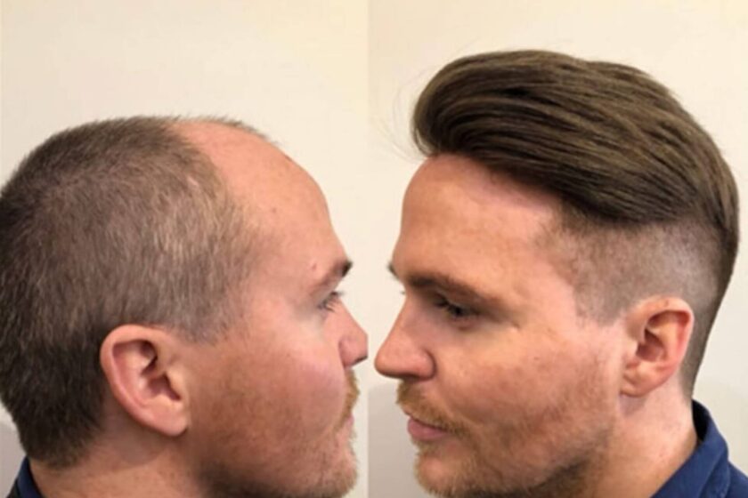 Hair Loss Integration Men's