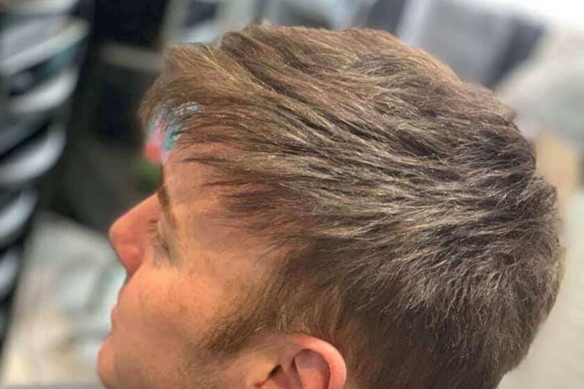 Male Hair Replacement
