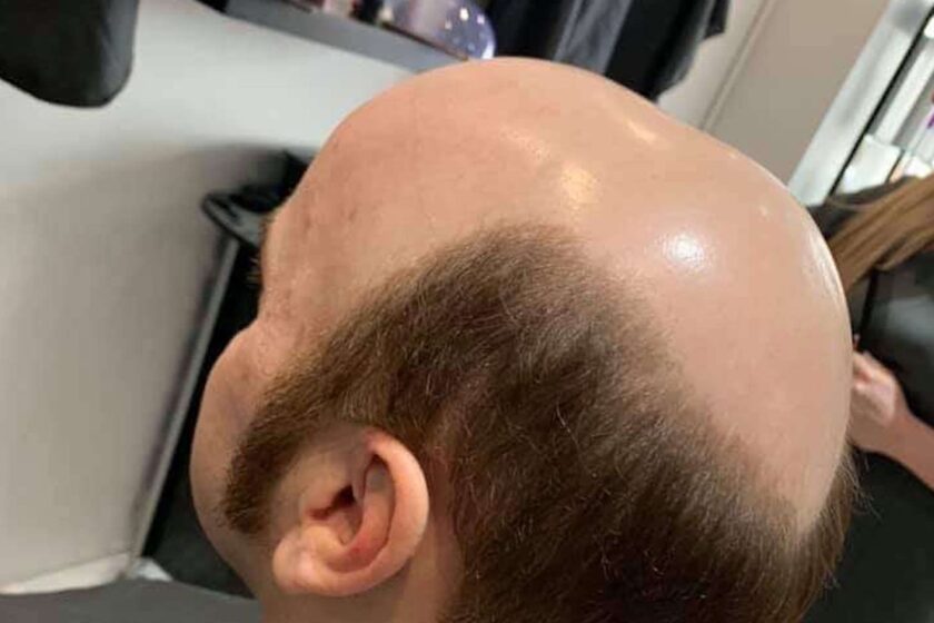 Male Hair Loss