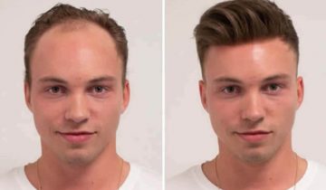 Online Men’s Hair Replacement