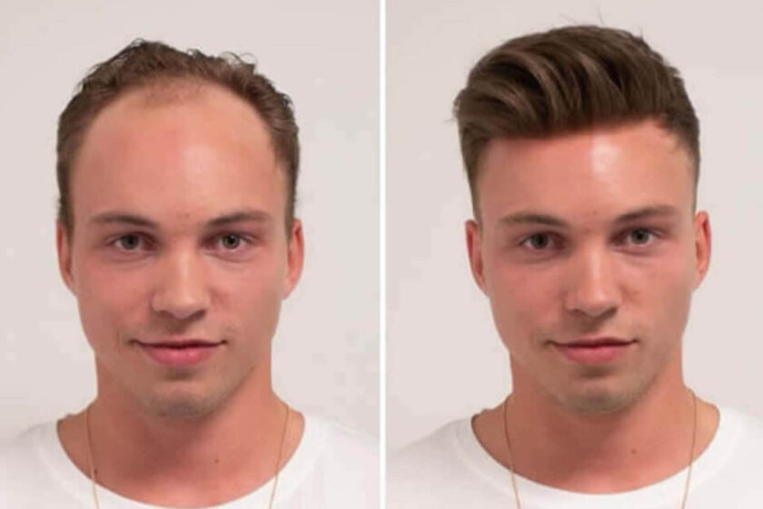 Men's Hair Replacement