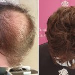 Male Baldness Hair Loss