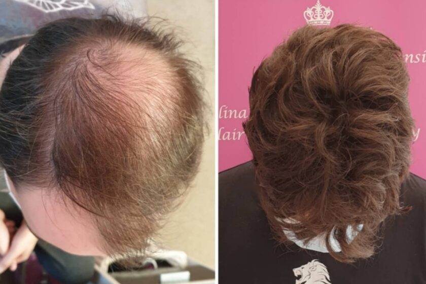 Male Baldness Hair Loss
