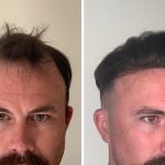 Mens Hair Loss