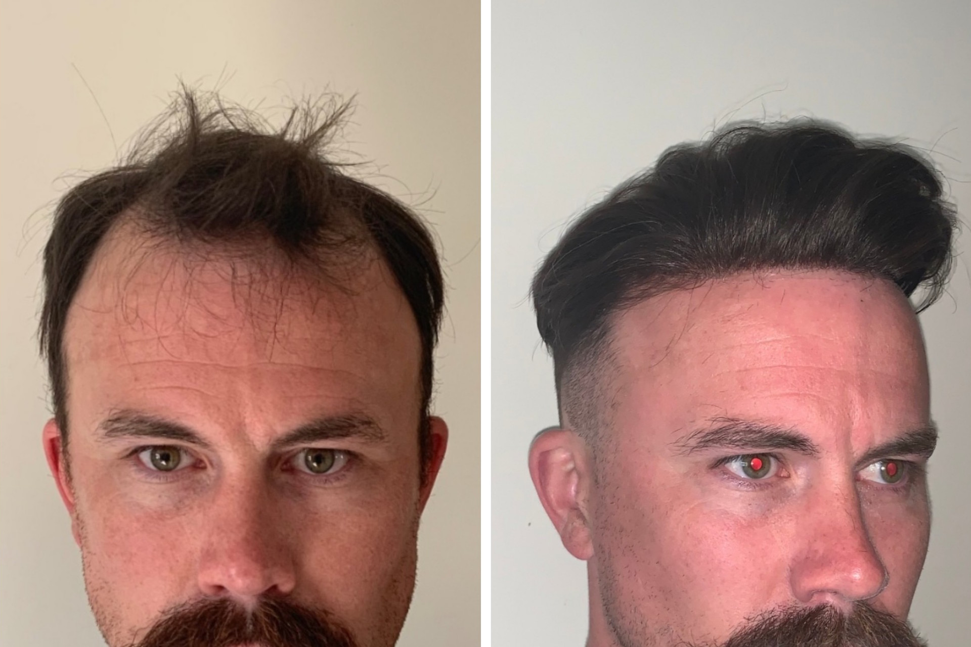 Men's Hair Replacement Training | Maxwell Melia Academy